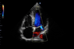 ecube15_platinum_gallery12_four_chamber_view_with_mitral_regurgitation_in_color