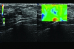 ecube15_platinum_gallery13_breast_with_elastography