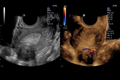 ecube15_platinum_gallery18_uterine_fibroid_in_dual_live_mode