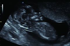 ecube15_platinum_gallery19_fetus_at_12_weeks_in_2d