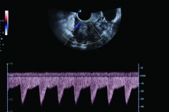 ecube15_platinum_gallery21_uterine_artery_in_pw