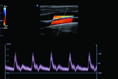 ecube15_platinum_gallery2_carotid_artery_in_pw