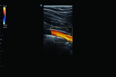 ecube15_platinum_gallery5_popliteal_artery_in_color