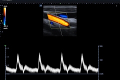 ecube8_diamond_gallery1_carotid_in_PW_Mode