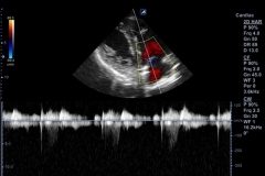 ecube9_diamond_gallery10_cw_doppler_of_tricuspid_regurgitation