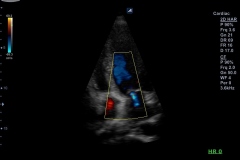 ecube9_diamond_gallery11_trivial_mitral_regurgitation_with_color_doppler