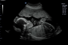 ecube9_diamond_gallery3_fetal_profile_view