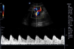 ecube9_diamond_gallery5_umbilical_artery_doppler_in_triplex_mode