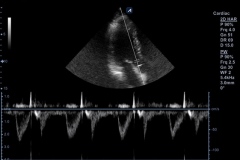 ecube9_diamond_gallery9_pw_doppler_in_lvot