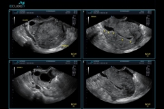 ecubei7_gallery8_nabothian_cyst_and_uterine_fibroid